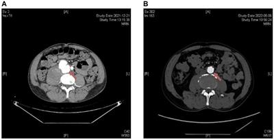 Brucella-infected abdominal aortic aneurysm: management strategies for an uncommon aneurysm